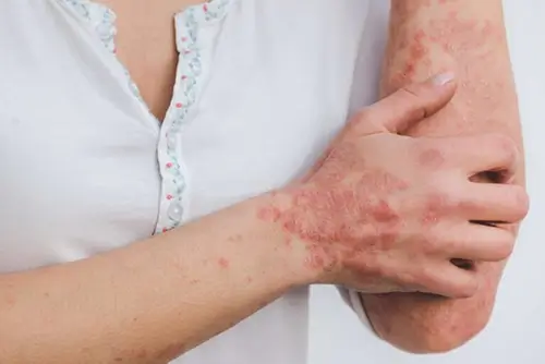 psoriasis